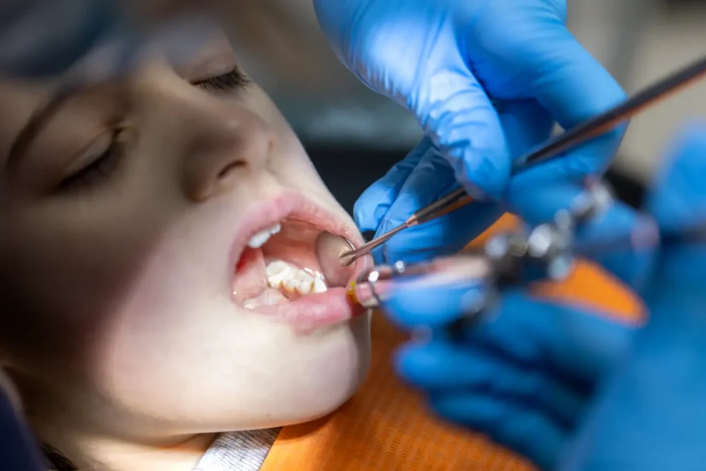 Wisdom Tooth Extraction in Moshi